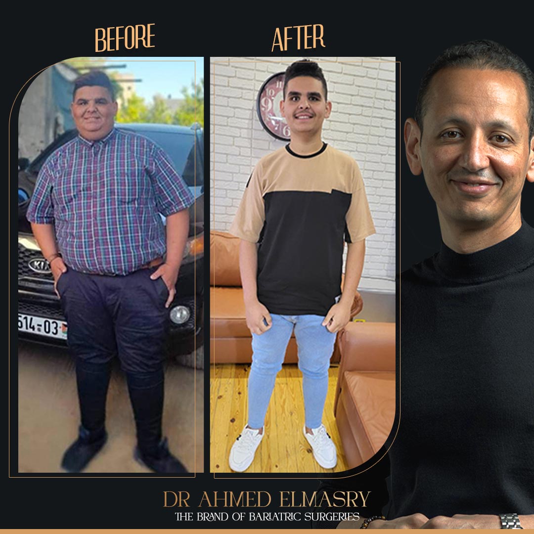 تكميم المعدة لشاب مع دكتور أحمد المصري